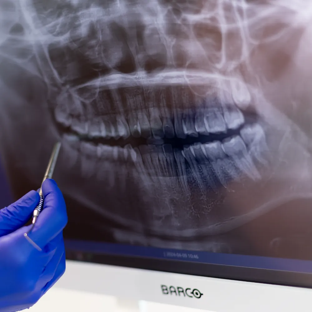 Ingyenes panoráma röntgen vagy 3D CBCT fogászati állapotfelmérés mellé